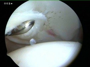 Footage of a labral tear from an arthroscopic hip surgery in Richmond, VA