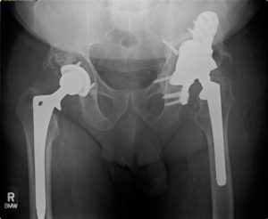 x-ray of complex revision left total hip arthroplasty utilizing a customized triflanged acetabular component