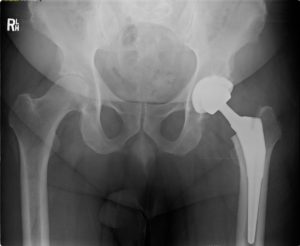 x ray left total hip replacement in richmond, virginia