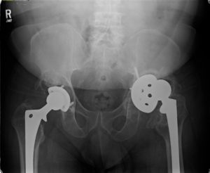 xray of patient with failed revision left total hip arthroplasty with acetabular loosening and bone loss