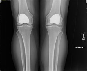patient xray of bilateral knee patellofemoral joint replacements with complete resolution of anterior knee pain 