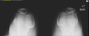xray from knee specialist in richmond va of patient with severe bilateral anterior knee pain and crepitus with stair climbing