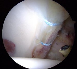photo of arthoscopic repair of hip acetabular labral tear in richmond va